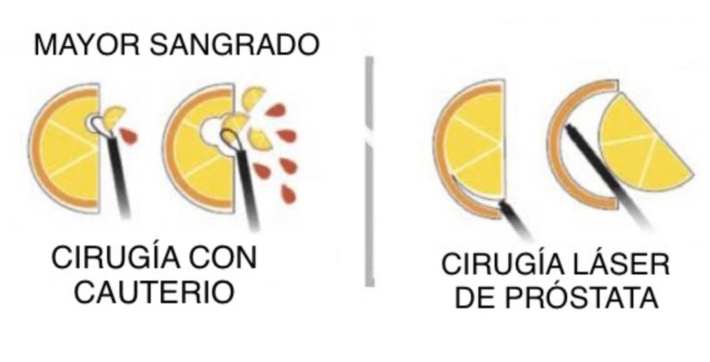 FIG. 3.1. DIFERENCIAS ENTRE CIRUGÍA CON CAUTERIO VS CIRUGÍA LÁSER DE PRÓSTATA.
