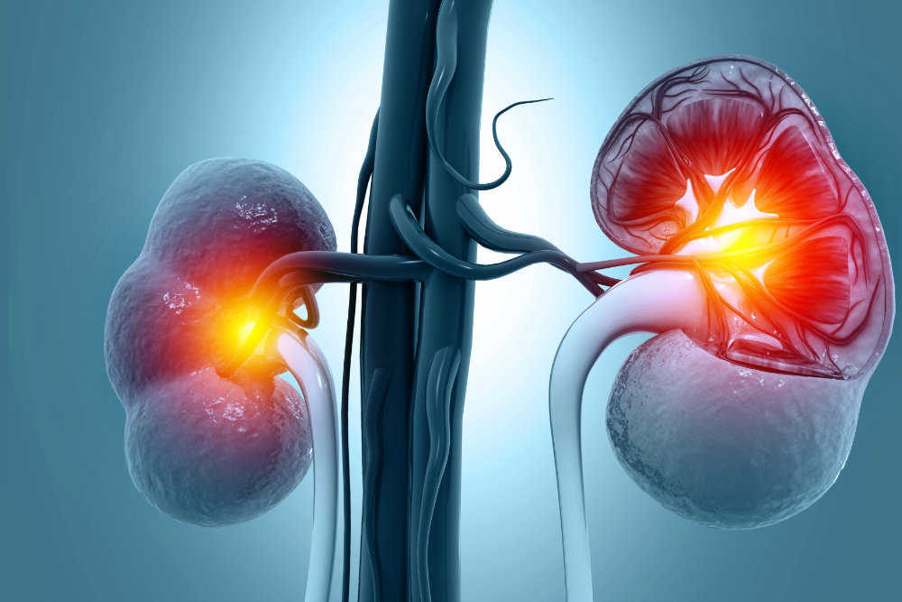 Percutaneous Renal Surgery, Urologist Monterrey