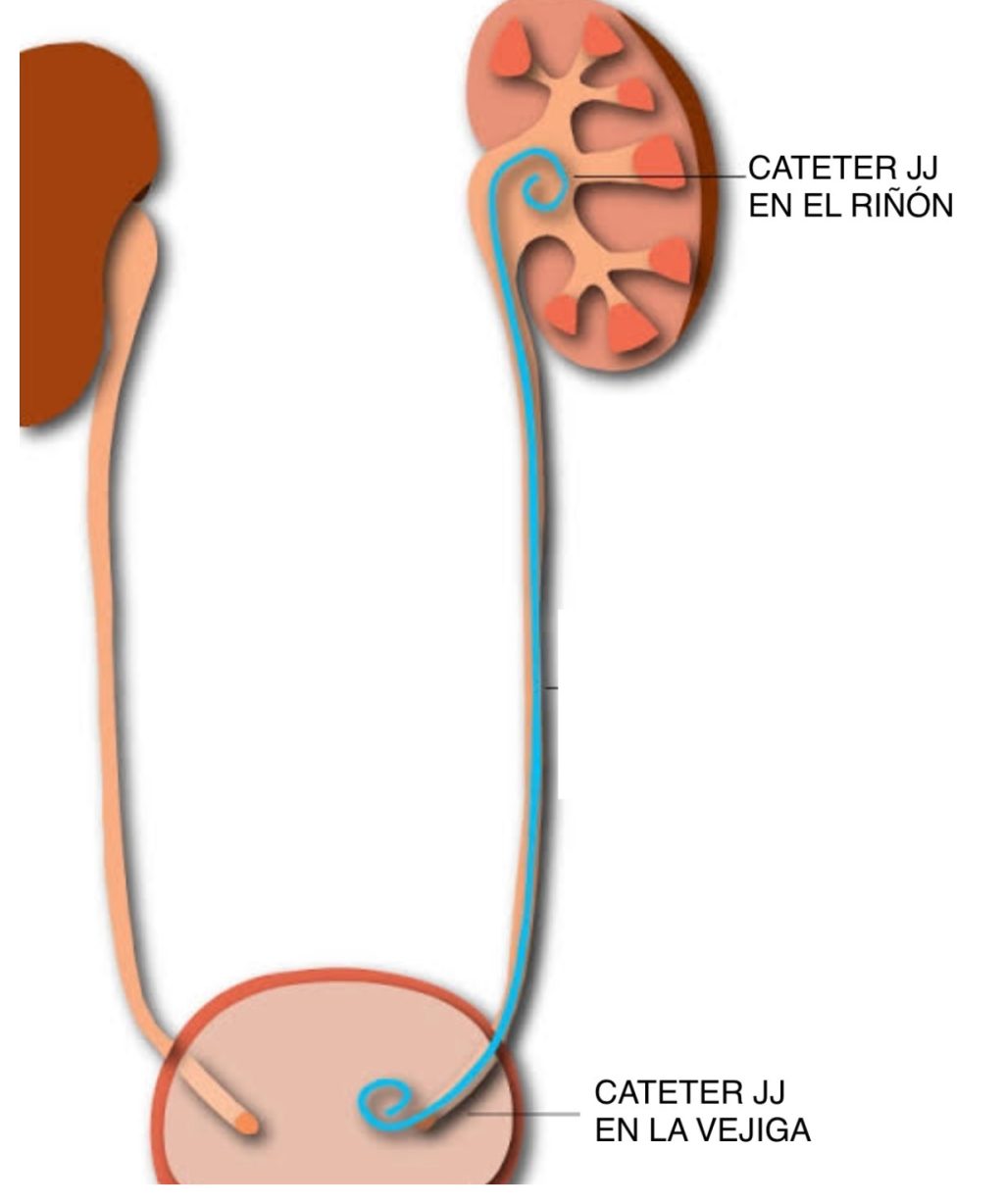 Cirugia LITIASIS CALCULOS, Piedras en las vias urinarias
